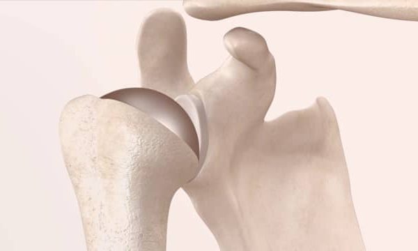 Primary Shoulder Replacement Patient Animation