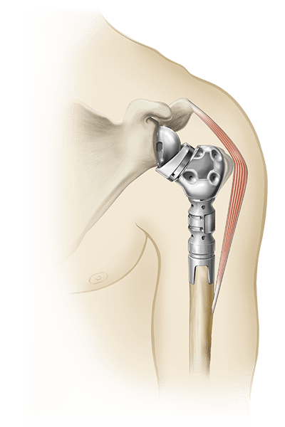 Equinoxe Humeral Reconstruction Prosthesis