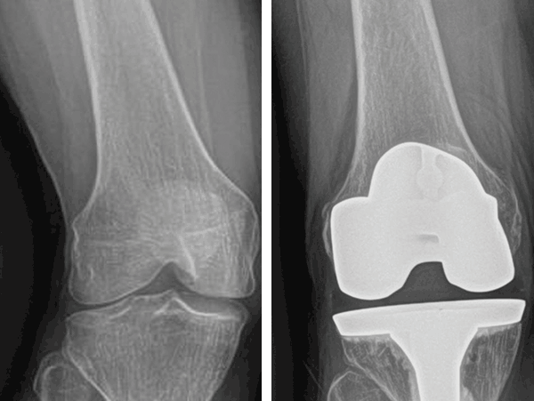 Knee Xray with Implant