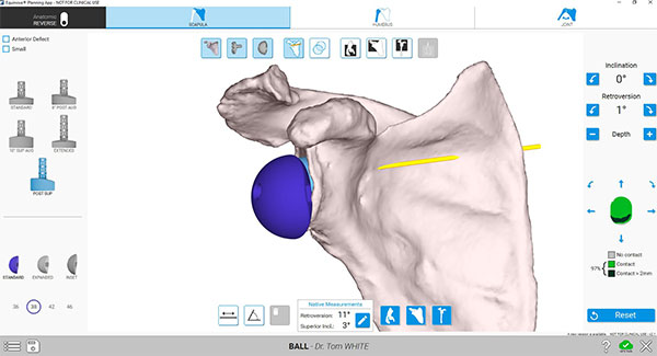 GPS Shoulder Application and Equinoxe Planning App Implant Placement Scapula