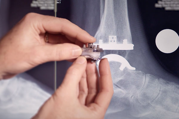 Exactech Ankle Replacement doctor showing ankle xray