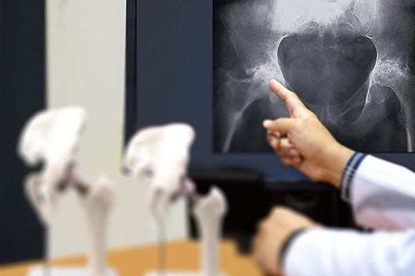 Exactech Hip Replacement Doctor showing a hip xray